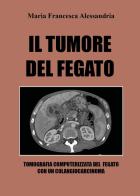 Il tumore del fegato di Maria Francesca Alessandria edito da Youcanprint