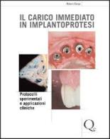 Il carico immediato in implantoprotesi di Roberto Crespi edito da Quintessenza