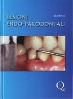 Lesioni endo-parodontali di Edoardo Foce edito da Quintessenza