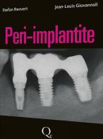 Peri-implantite di Stefan Renvert, Jean-Louis Giovannoli edito da Quintessenza