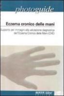 Eczema cronico delle mani. Supporto per immagini alla valutazione diagnostica dell'eczema cronico delle mani edito da Maya Idee