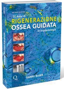 20 anni di rigenerazione ossea guidata in implantologia.pdf