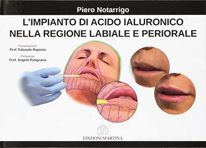 L impianto di acido ialuronico nella regione labiale e periorale.pdf