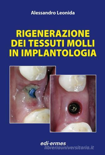 Rigenerazione dei tessuti molli in implantologia di Alessandro Leonida edito da Edi. Ermes