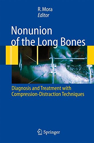 Nununion of the long bones. Diagnosis and treatment with compression-distraction techniques di Redento Mora edito da Springer Verlag