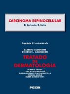 Ebook Capítulo 91 extraído de Tratado de Dermatología - CARCINOMA ESPINOCELULAR di A.Giannetti, D. Cerimele, R. Satta edito da Piccin Nuova Libraria Spa