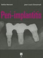 Peri-Implantitis di Stefan Renvert edito da Quintessence Publishing (IL)