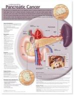 Understanding Pancreatic Cancer Anatomical Chart edito da Lippincott Williams And Wilkins