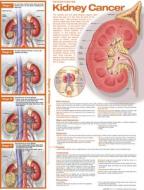 Understanding Kidney Cancer Anatomical Chart edito da Wolters Kluwer Health