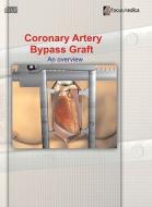 Coronary Artery Bypass Graft (Cabg): An Overview edito da Mercury Learning & Information