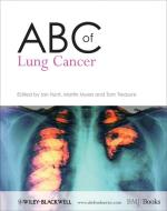 ABC of Lung Cancer edito da John Wiley and Sons Ltd