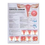 Understanding Cervical Cancer Anatomical Chart edito da Lippincott Williams And Wilkins