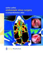 Endoscopic Sinus Surgery di Carlos Yañez edito da Springer Vienna