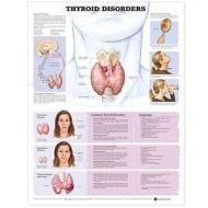 Thyroid Disorders Anatomical Chart edito da Anatomical Chart Co.