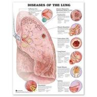 Diseases Of The Lung Anatomical Chart edito da Anatomical Chart Co.