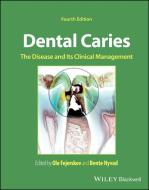 Dental Caries: The Disease And Its Clinical Manage Ment 4th Edition edito da BLACKWELL PUBL