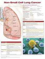 Non-Small Cell Lung Cancer di Anatomical Chart Company edito da Lippincott Williams And Wilkins