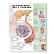 Understanding Type 2 Diabetes Anatomical Chart edito da Anatomical Chart Co.