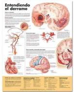 Understanding Stroke Anatomical Chart In Spanish (entendiendo Que Es Un Derrame) edito da Anatomical Chart Co.
