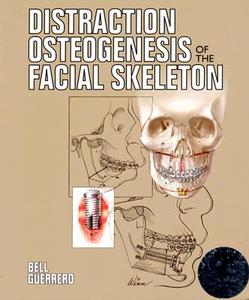 Distraction Osteogenesis of the Facial Skeleton di William Bell edito da McGraw-Hill Education