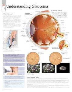 Understanding Glaucoma Laminated Poster di Scientific Publishing edito da Scientific Publishing Limited