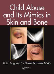 Child Abuse and its Mimics in Skin and Bone di B. G. Brogdon edito da CRC Press