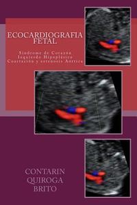 Ecocardiografia Fetal: Sindrome de Corazon Izquierdo Hipoplasico. Coartacion y Estenosis Aortica. di Francesco Contarin MD, Hector Quiroga MD, Julio Brito MD edito da Createspace