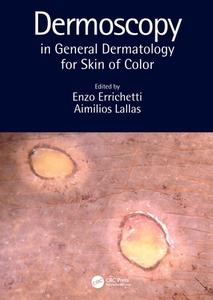 Dermoscopy In General Dermatology For Skin Of Color edito da Taylor & Francis Ltd