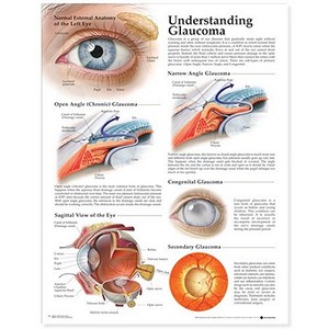 Understanding Glaucoma Anatomical Chart edito da Anatomical Chart Co.