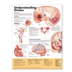 Understanding Stroke Anatomical Chart edito da Anatomical Chart Co.